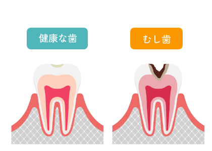むし歯