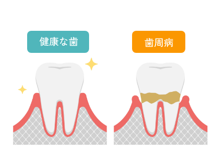 歯周病治療